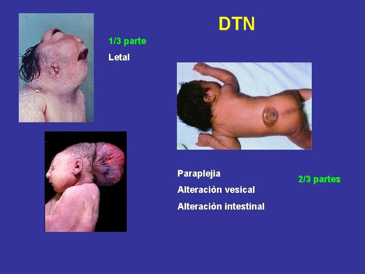 DTN 1/3 parte Letal Paraplejia Alteraciòn vesical Alteraciòn intestinal 2/3 partes 