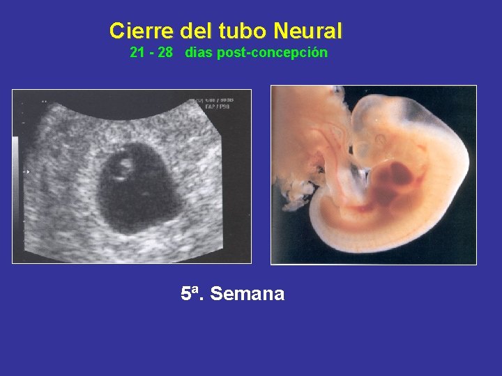 Cierre del tubo Neural 21 - 28 dias post-concepción 5ª. Semana 