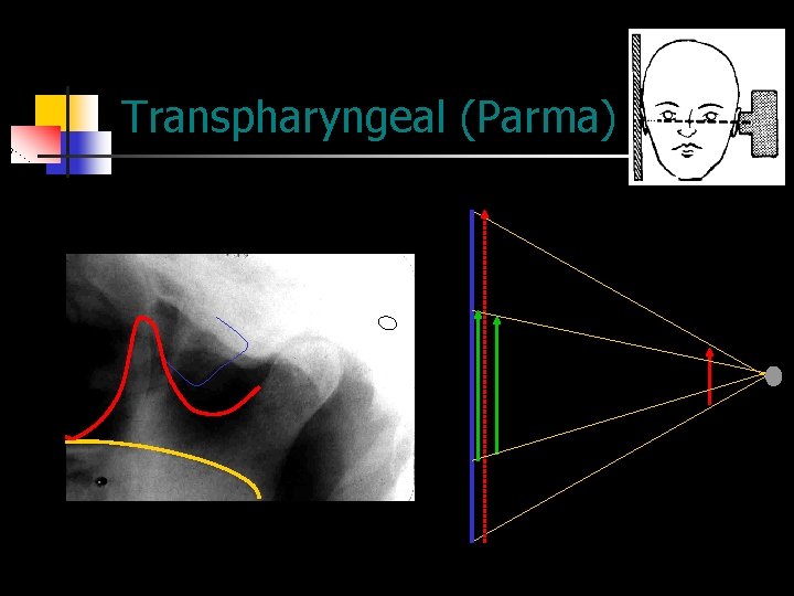 Transpharyngeal (Parma) 
