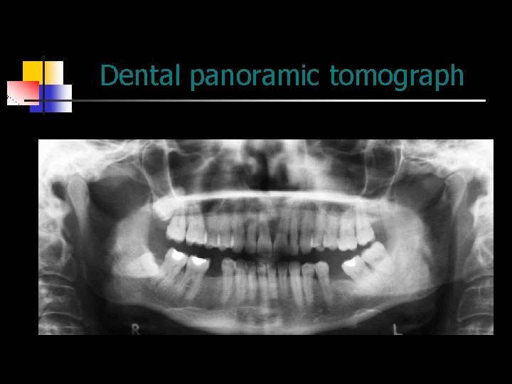 Dental panoramic tomograph 