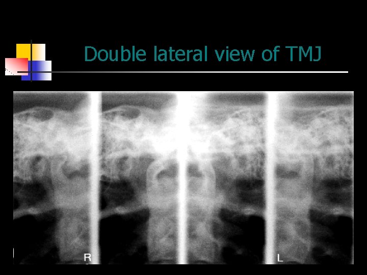 Double lateral view of TMJ 