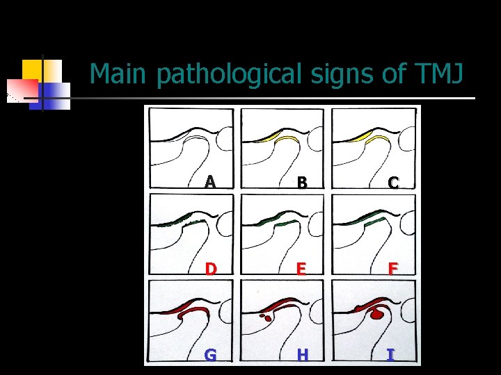 Main pathological signs of TMJ A B C D E F G H I