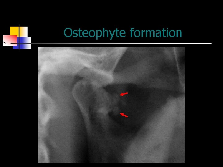 Osteophyte formation 