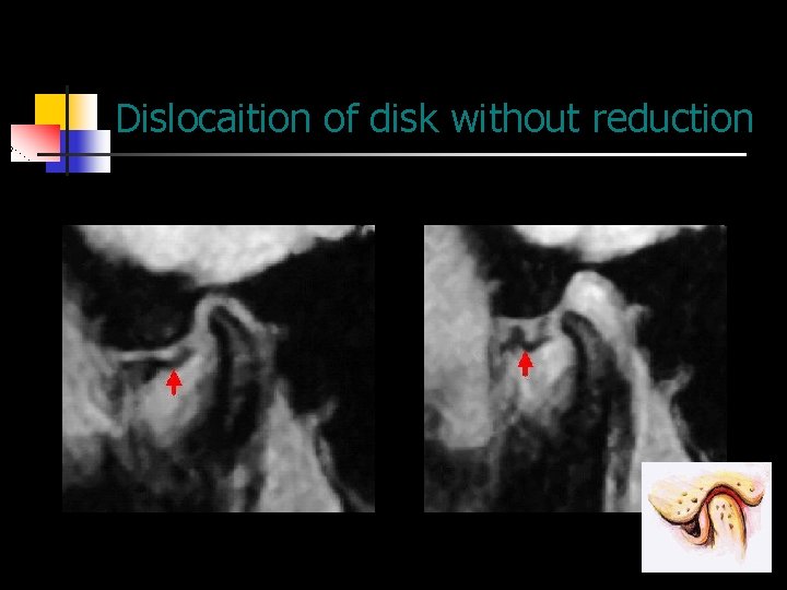Dislocaition of disk without reduction 