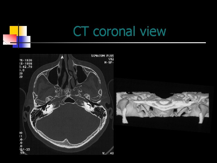 CT coronal view 