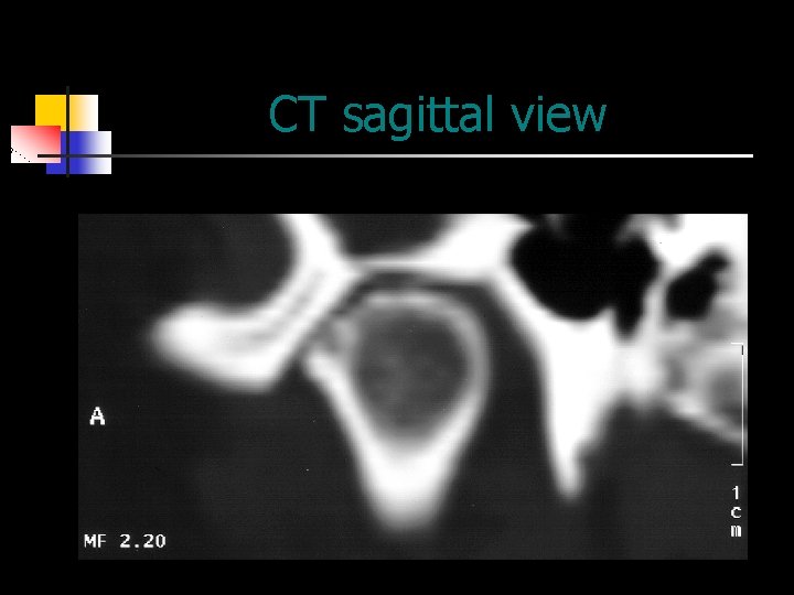 CT sagittal view 