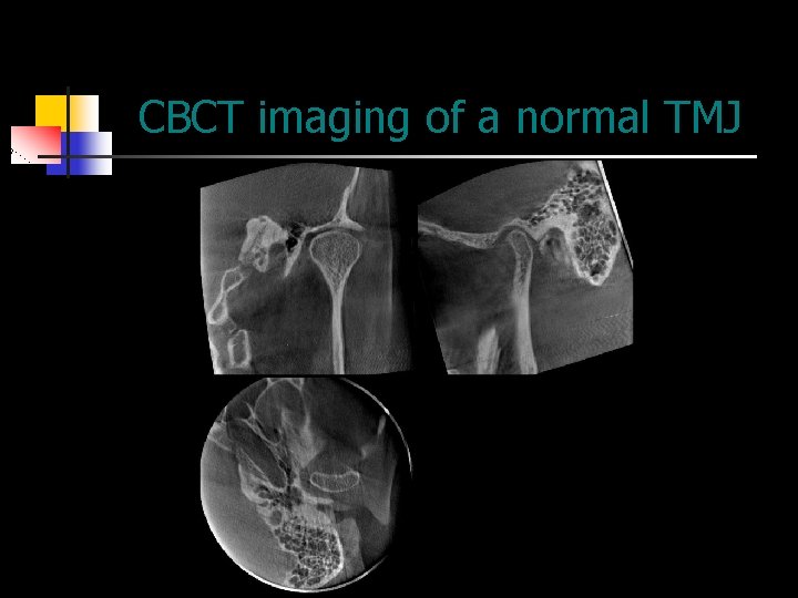 CBCT imaging of a normal TMJ 