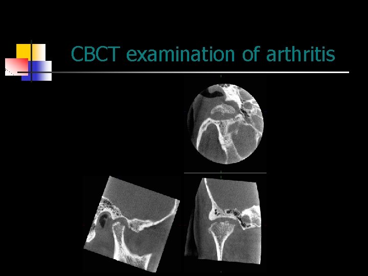 CBCT examination of arthritis 