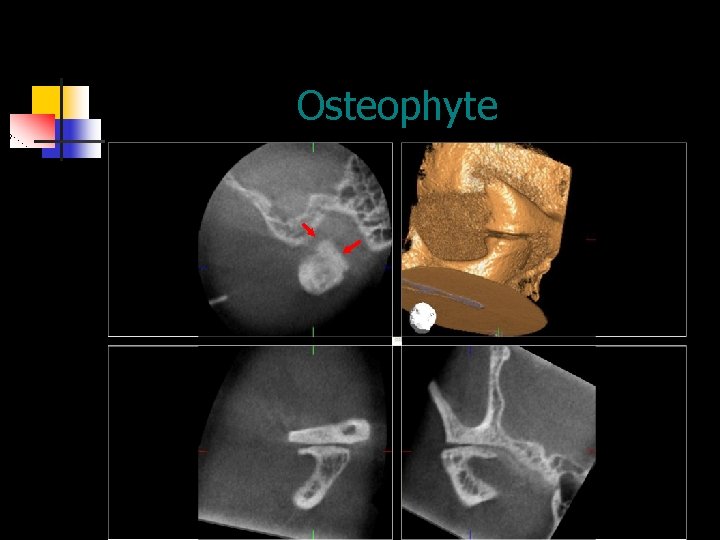 Osteophyte 