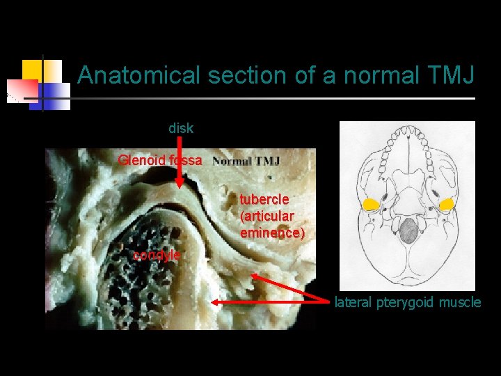 Anatomical section of a normal TMJ disk Glenoid fossa tubercle (articular eminence) condyle lateral