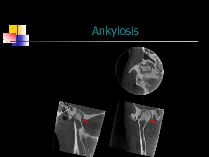 Ankylosis 