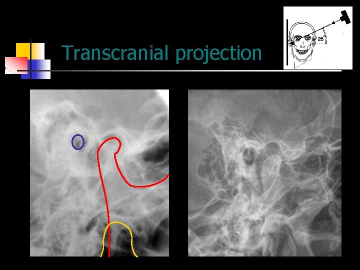 Transcranial projection 