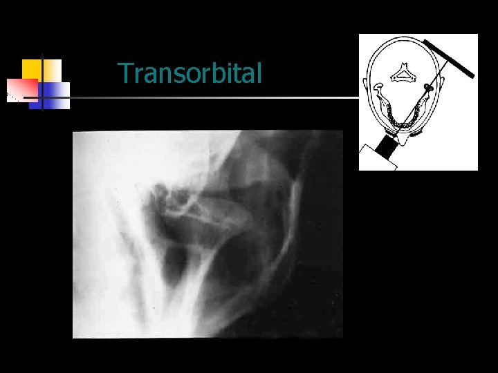 Transorbital 
