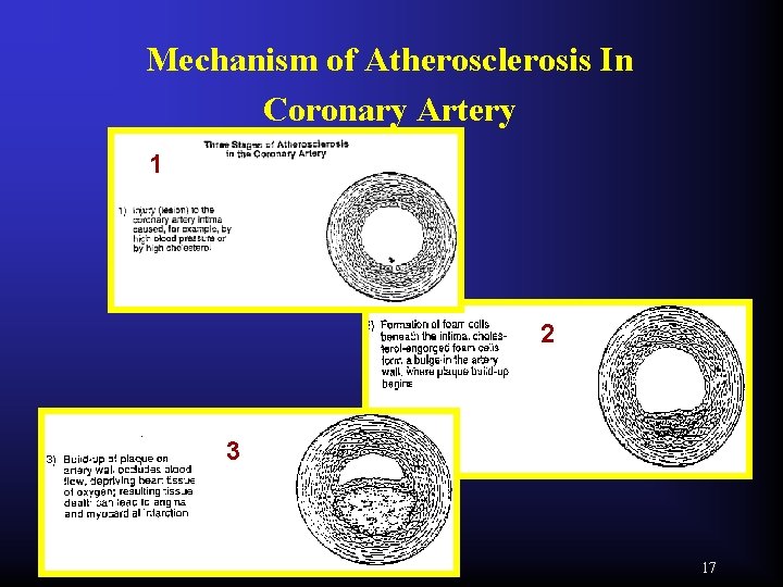 Mechanism of Atherosclerosis In Coronary Artery 1 2 3 17 