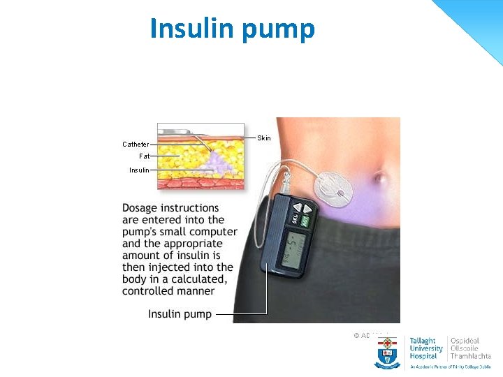 Insulin pump 