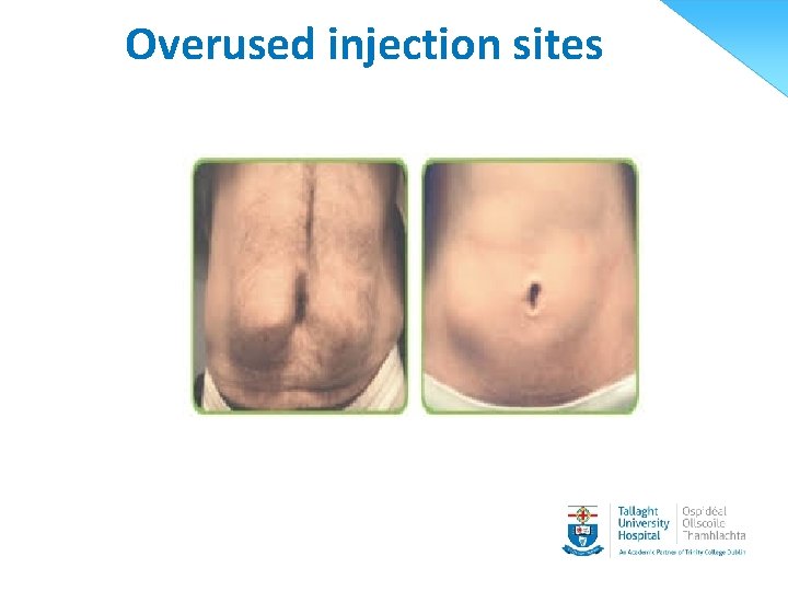 Overused injection sites 