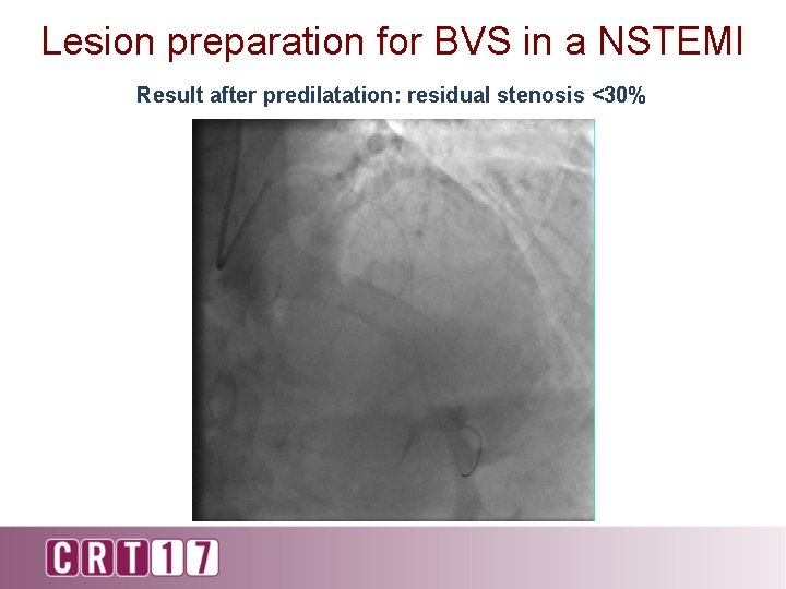 Lesion preparation for BVS in a NSTEMI Result after predilatation: residual stenosis <30% 