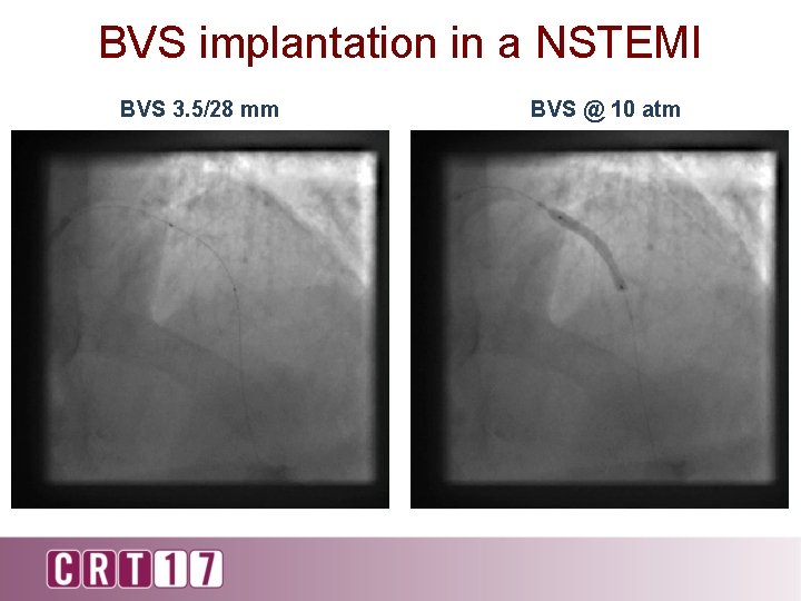BVS implantation in a NSTEMI BVS 3. 5/28 mm BVS @ 10 atm 