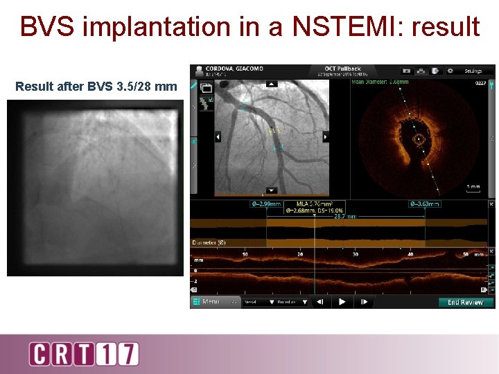 BVS implantation in a NSTEMI: result Result after BVS 3. 5/28 mm 