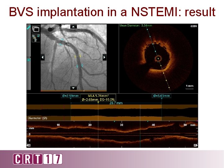 BVS implantation in a NSTEMI: result 