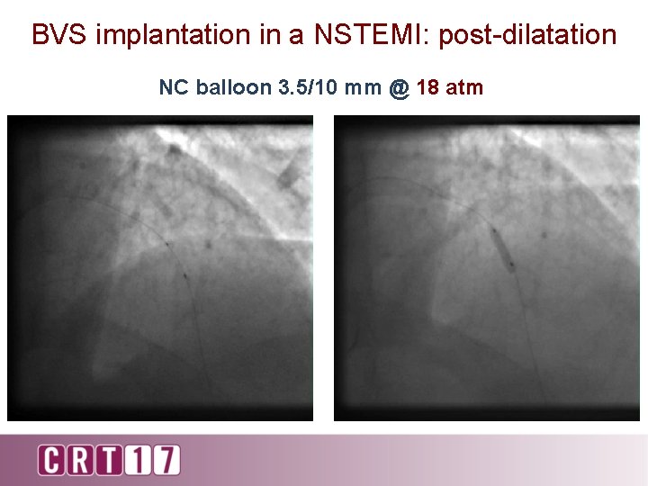 BVS implantation in a NSTEMI: post-dilatation NC balloon 3. 5/10 mm @ 18 atm