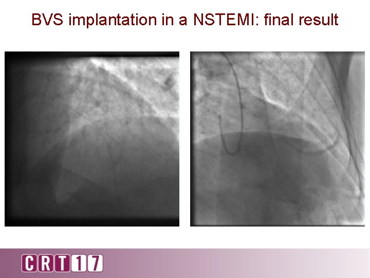 BVS implantation in a NSTEMI: final result 