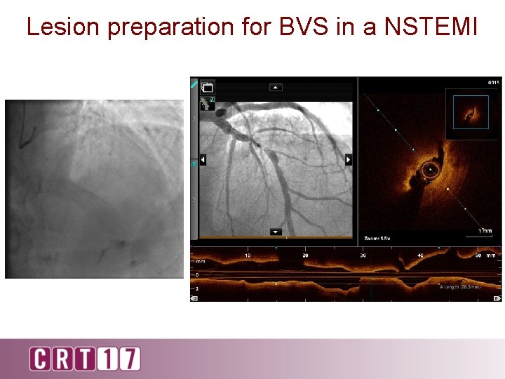 Lesion preparation for BVS in a NSTEMI 