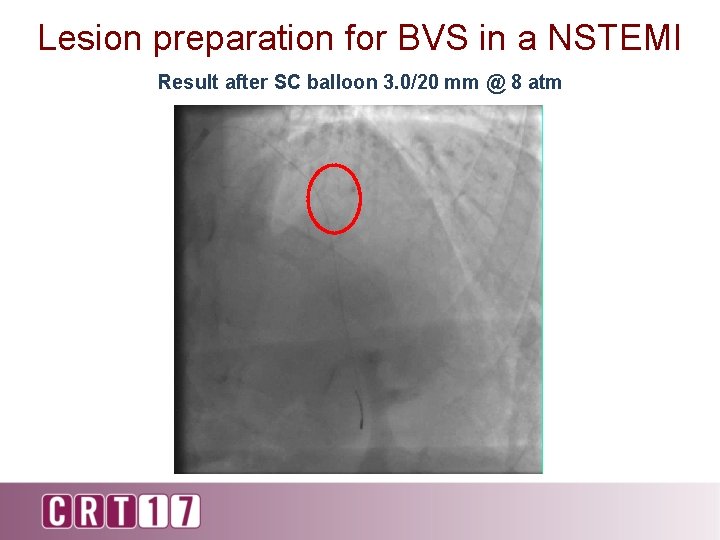 Lesion preparation for BVS in a NSTEMI Result after SC balloon 3. 0/20 mm