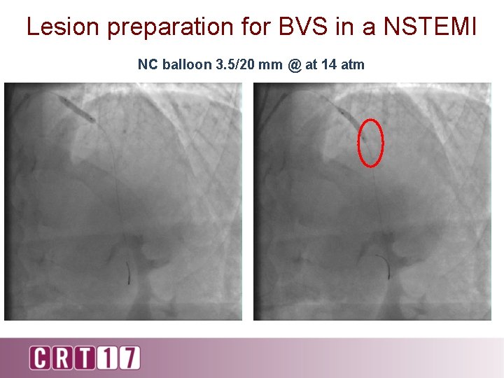 Lesion preparation for BVS in a NSTEMI NC balloon 3. 5/20 mm @ at