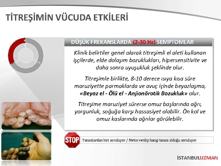 DÜŞÜK FREKANSLARDA (2 -30 Hz) SEMPTOMLAR Klinik belirtiler genel olarak titreşimli el aleti kullanan