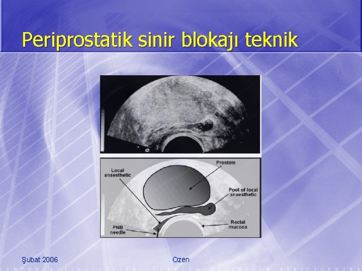 Periprostatik sinir blokajı teknik Şubat 2006 Ozen 