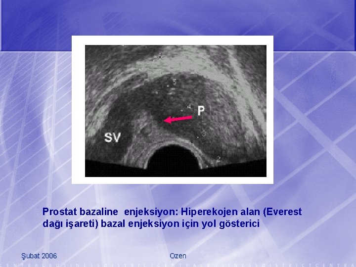 Prostat bazaline enjeksiyon: Hiperekojen alan (Everest dağı işareti) bazal enjeksiyon için yol gösterici Şubat