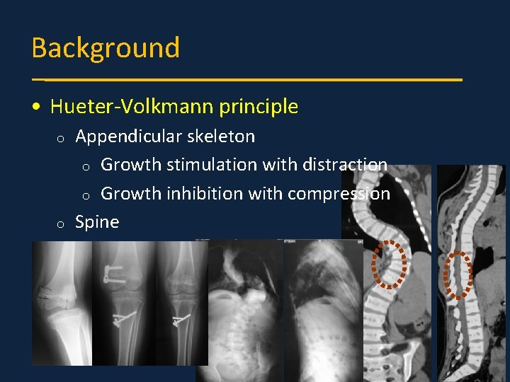 Background • Hueter-Volkmann principle o o Appendicular skeleton o Growth stimulation with distraction o
