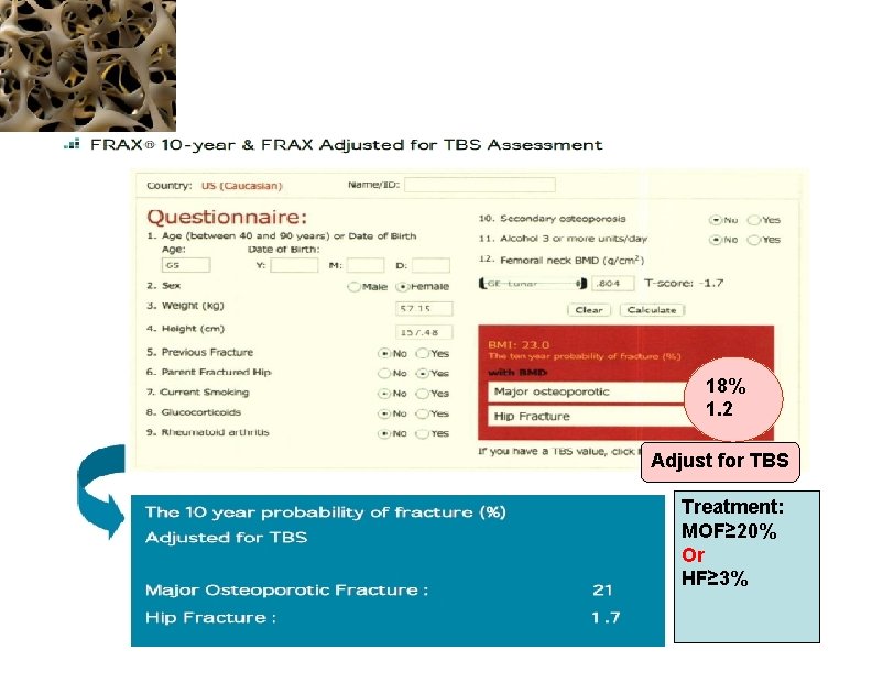 18% 1. 2 Adjust for TBS Treatment: MOF≥ 20% Or HF≥ 3% 