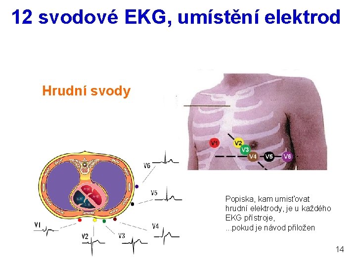 12 svodové EKG, umístění elektrod Hrudní svody Popiska, kam umisťovat hrudní elektrody, je u