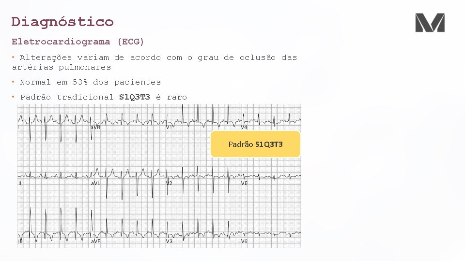 Diagnóstico Eletrocardiograma (ECG) • Alterações variam de acordo com o grau de oclusão das