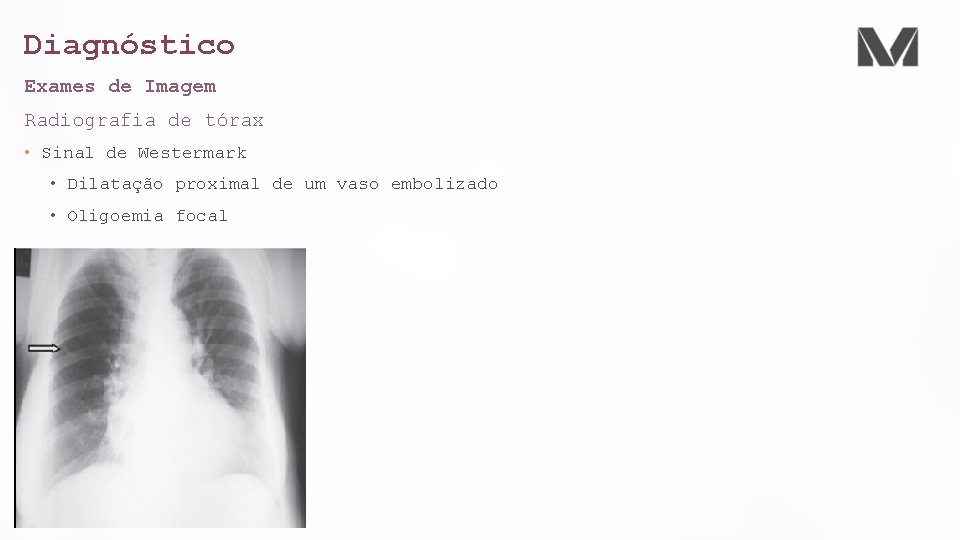Diagnóstico Exames de Imagem Radiografia de tórax • Sinal de Westermark • Dilatação proximal