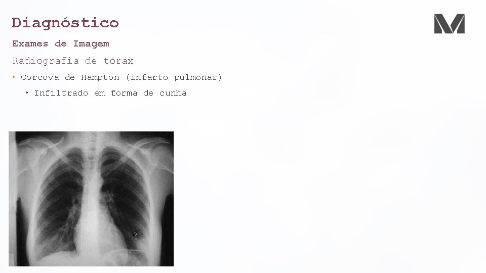 Diagnóstico Exames de Imagem Radiografia de tórax • Corcova de Hampton (infarto pulmonar) •
