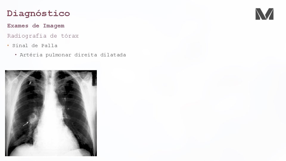 Diagnóstico Exames de Imagem Radiografia de tórax • Sinal de Palla • Artéria pulmonar