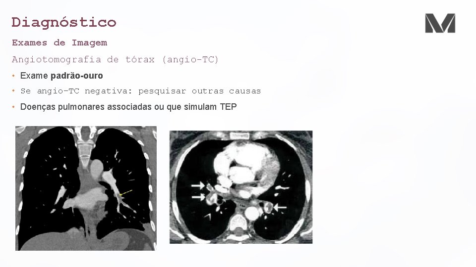 Diagnóstico Exames de Imagem Angiotomografia de tórax (angio-TC) • Exame padrão-ouro • Se angio-TC