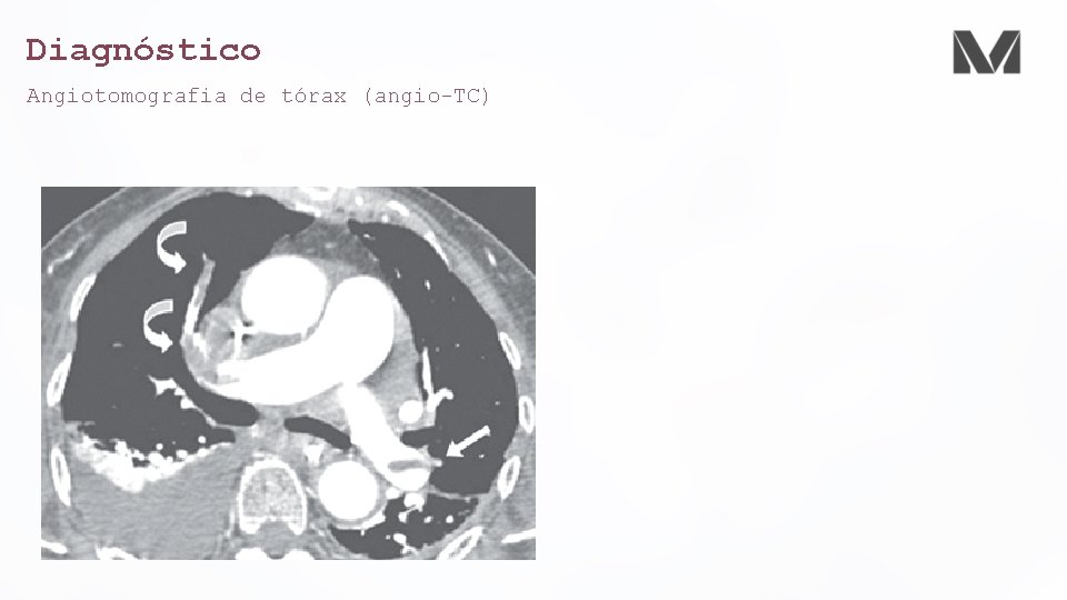 Diagnóstico Angiotomografia de tórax (angio-TC) 