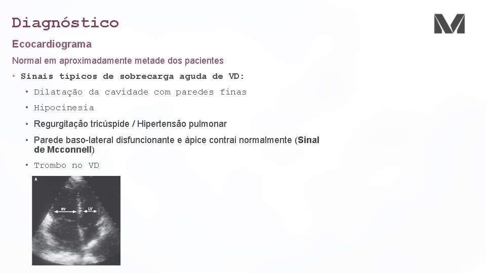 Diagnóstico Ecocardiograma Normal em aproximadamente metade dos pacientes • Sinais típicos de sobrecarga aguda