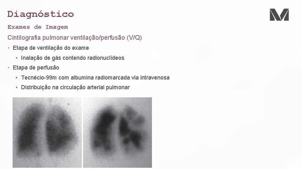 Diagnóstico Exames de Imagem Cintilografia pulmonar ventilação/perfusão (V/Q) • Etapa de ventilação do exame