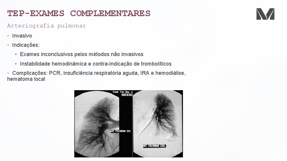 TEP-EXAMES COMPLEMENTARES Arteriografia pulmonar • Invasivo • Indicações: • Exames inconclusivos pelos métodos não