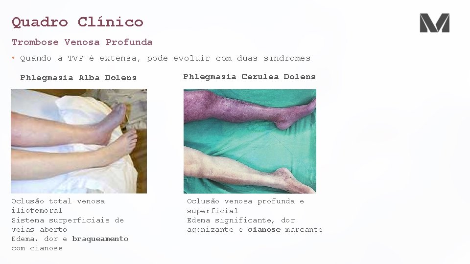 Quadro Clínico Trombose Venosa Profunda • Quando a TVP é extensa, pode evoluir com