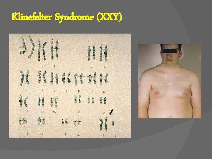 Klinefelter Syndrome (XXY) 