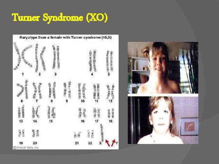 Turner Syndrome (XO) 