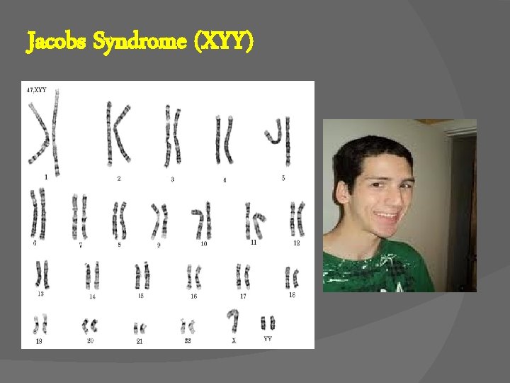 Jacobs Syndrome (XYY) 