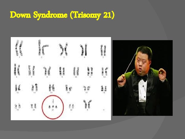 Down Syndrome (Trisomy 21) 