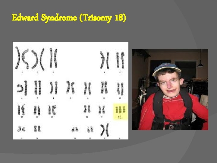 Edward Syndrome (Trisomy 18) 